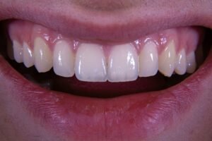 Is Cosmetic Bonding in Plantation Right for Your Small Tooth Flaws?